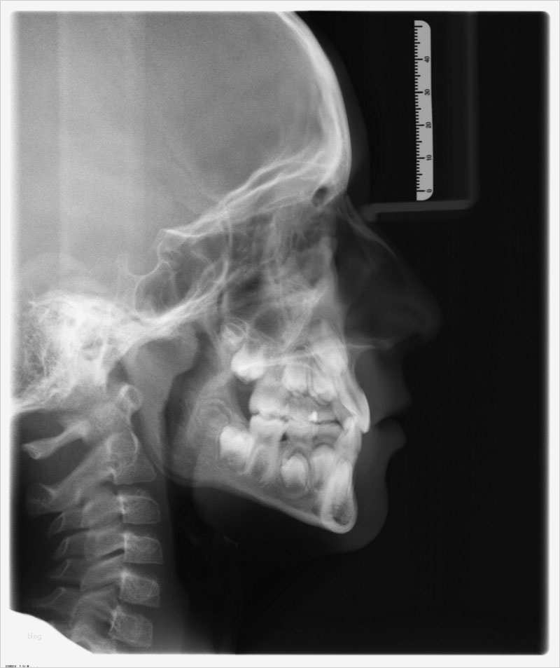 Kostenübernahme Krankenkasse Vorlage Erstaunlich Behandlungsablauf Beim Kieferorthopäden In Bonn Röttgen