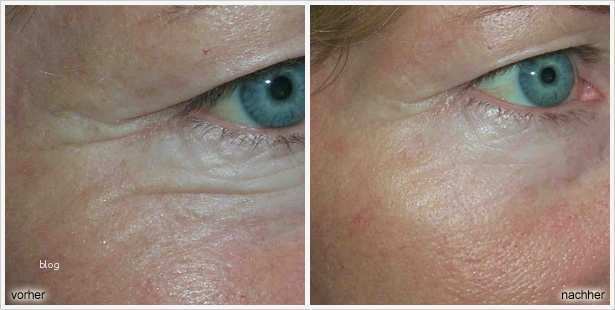 Kostenübernahme Krankenkasse Vorlage Großartig Augencreme Gegen Falten Test 2013 Vorlage