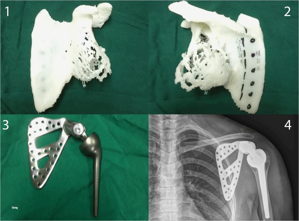 Vorlagen Für 3d Drucker Schön Rekonstruktion Mit Dem 3d Drucker 3d Druck Magazin