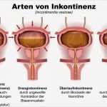 Vorlagen Für Männer Inkontinenz Einzigartig Inkontinenz Harninkontinenz Stuhlinkontinenz