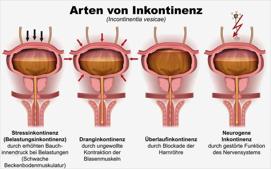 Vorlagen Für Männer Inkontinenz Einzigartig Inkontinenz Harninkontinenz Stuhlinkontinenz
