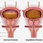 Vorlagen Bei Inkontinenz Für Männer Genial Inkontinenz Nach Prostata Op • Ratgeber Inkontinenz &amp; Prostata