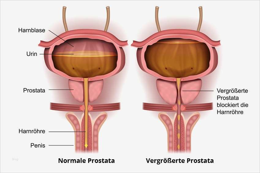 Inkontinenz nach Prostata OP • Ratgeber Inkontinenz & Prostata